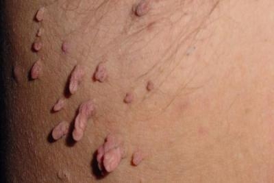 Skidanje promena na koži radiotalasnom hirurgijom - virusne bradavice, keratoze, fibromi, papilomi
